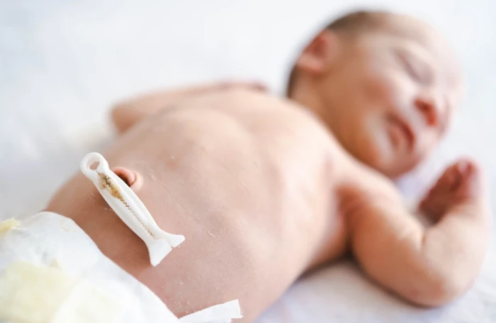Pupak kod beba - kako da pravilnom negom sprečite komplikacije?